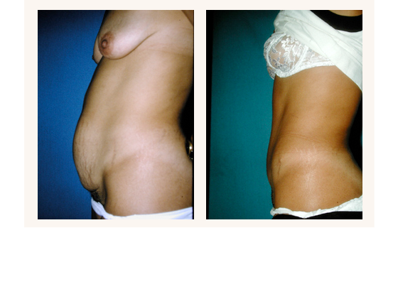 abdominoplasty1