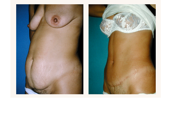 abdominoplasty2