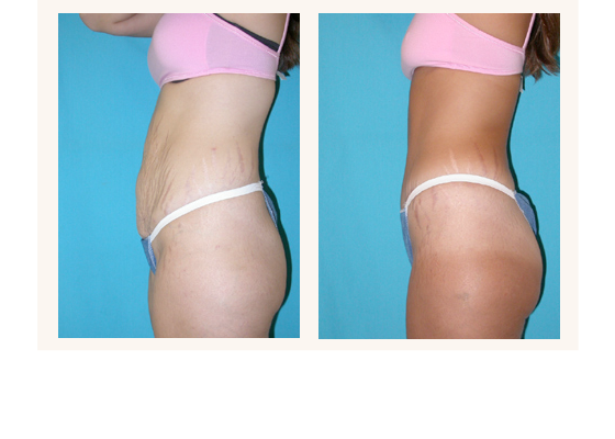 abdominoplasty3