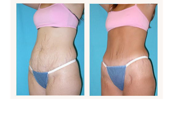 abdominoplasty4