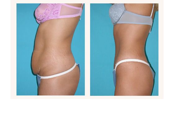 abdominoplasty5