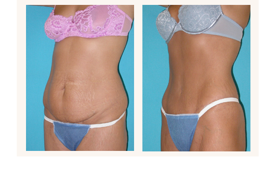 abdominoplasty6