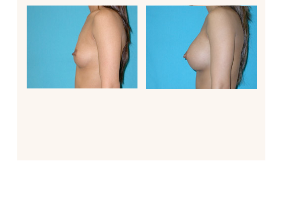 breastaugmentation10