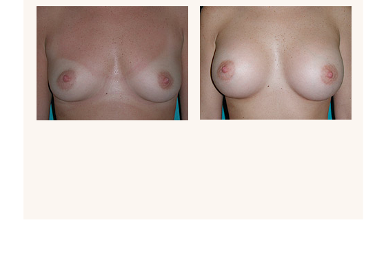 breastaugmentation1