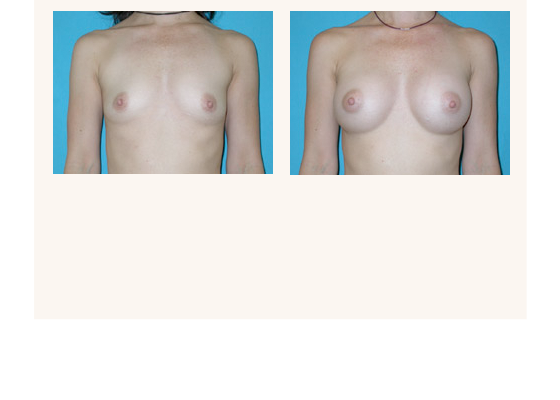 breastaugmentation11