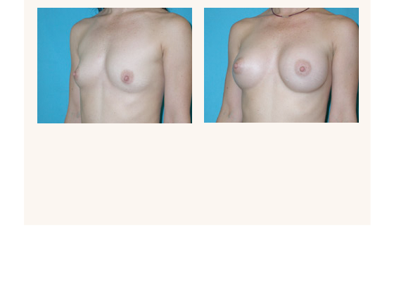 breastaugmentation12