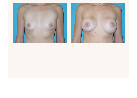 breastaugmentation13