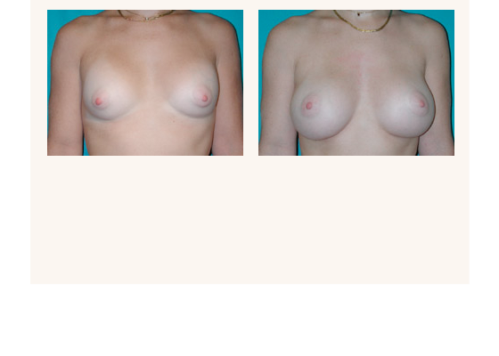 breastaugmentation15