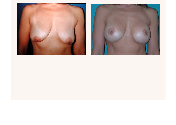 breastaugmentation19