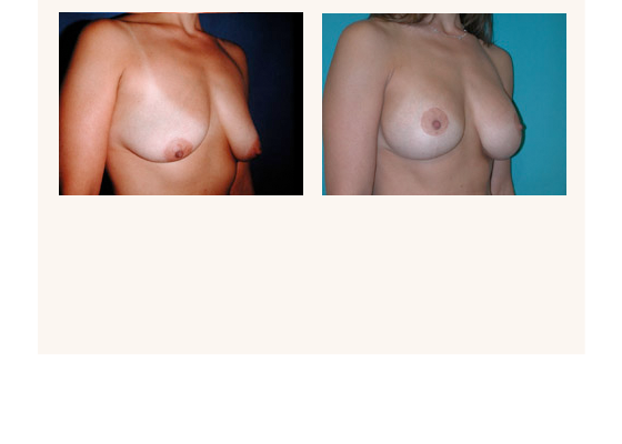 breastaugmentation20