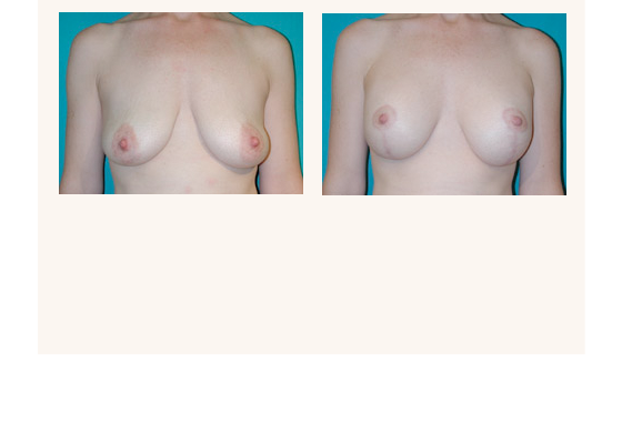 breastaugmentation21