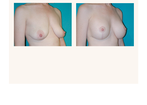 breastaugmentation22