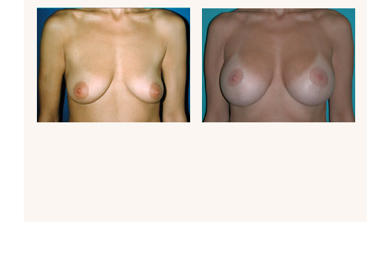 breastaugmentation23