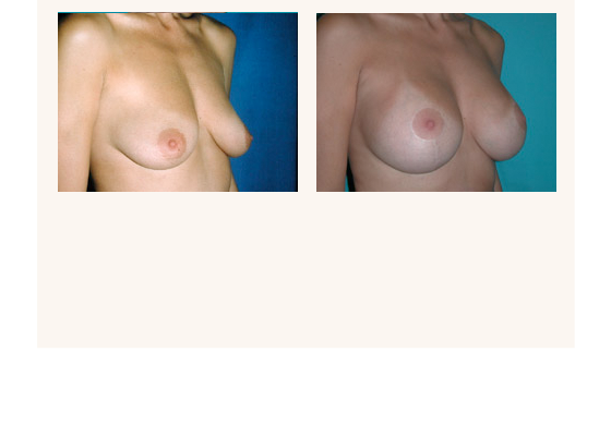 breastaugmentation24