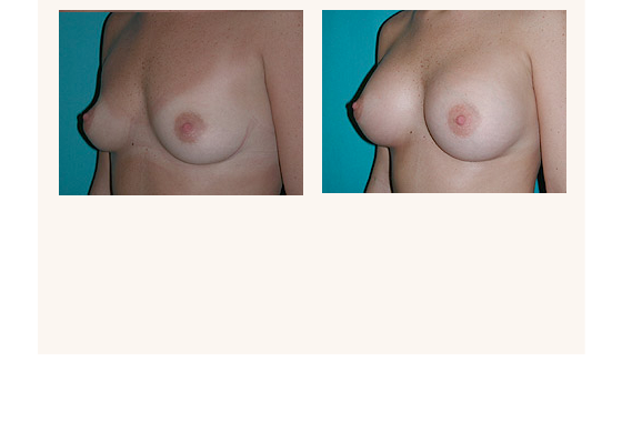 breastaugmentation2