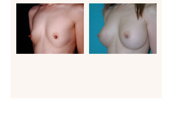 breastaugmentation8