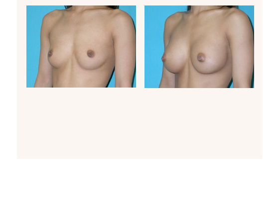 breastaugmentation9