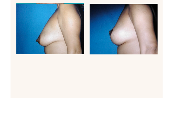 breastlift1