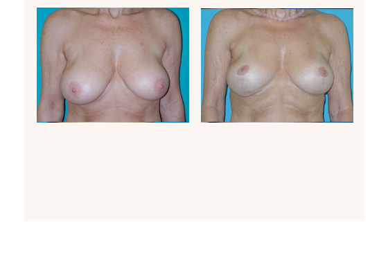 breastlift3