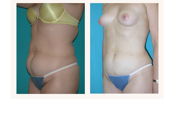 liposuction1