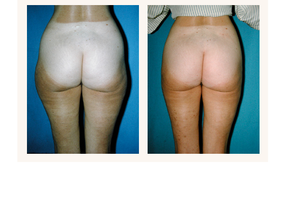 liposuction3