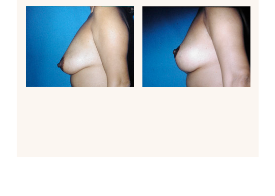 breastlift1