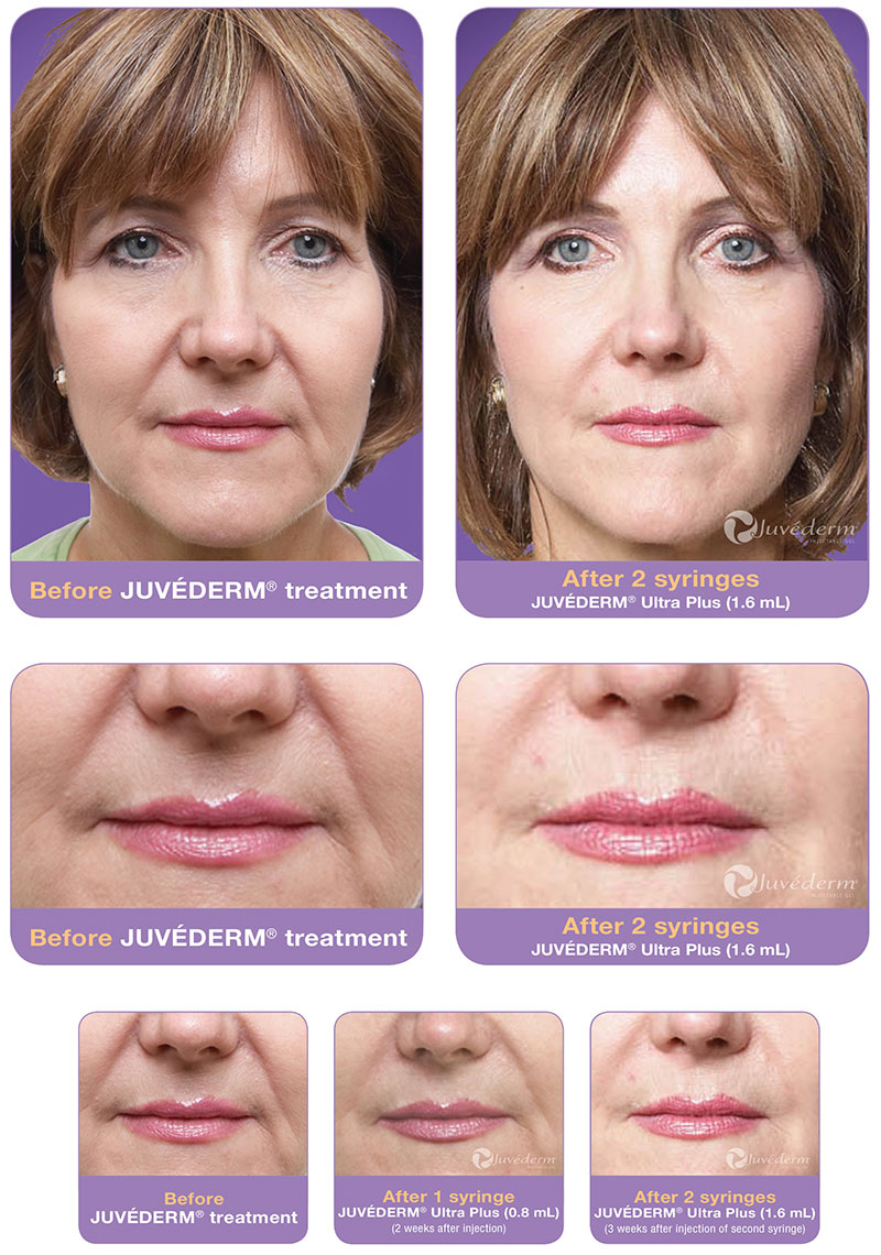 juvederm-dr-seung-k-kim-palo-alto-plastic-surgeondr-seung-k-kim